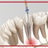 ایمنی و نکات کلیدی کار با فایل‌های روتاری در درمان ریشه